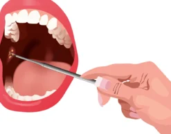 MiBrush Tonsil Stones Loop Extractor (amandelstenen)