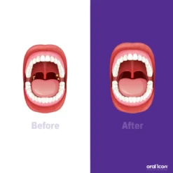 Oral Icon® Amandelstenen Cupping Kit